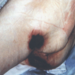 Pressure sores on the buttocks of a neglected, bedbound older person
