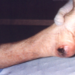 Pressure sore on the heel of a bedbound elder neglect victim. This was caused by constant pressure of the heel against a surface such as a bed.