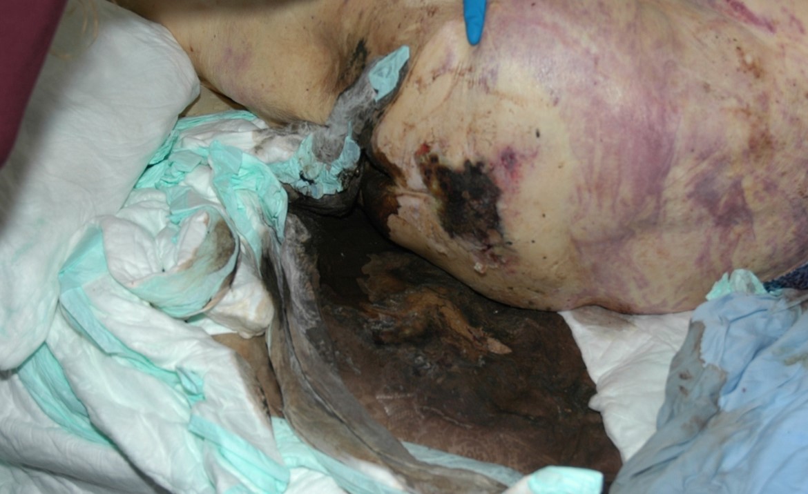 A pressure ulcer in the buttocks region embedded with feces. Note the clothing, bedding and pads at the scene of a decedent.